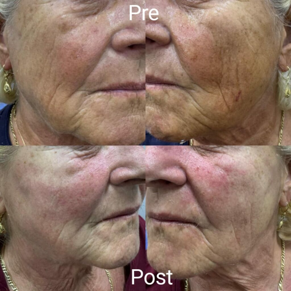 Improvement in facial lines after one session of PLLA injections
